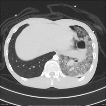 Pneumatocele | Radiology Reference Article | Radiopaedia.org