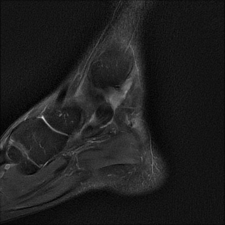 Tibialis posterior tendon rupture | Radiology Case | Radiopaedia.org