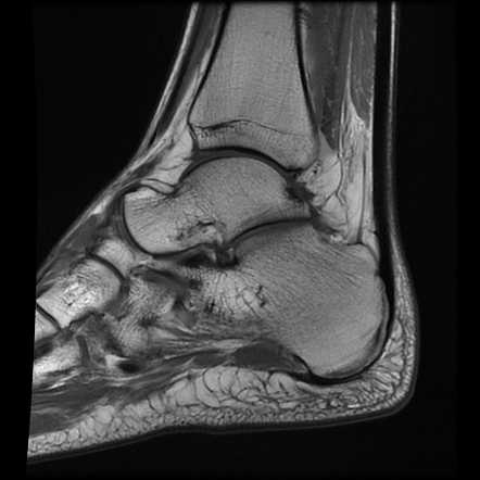 Tibialis posterior tendon rupture | Image | Radiopaedia.org