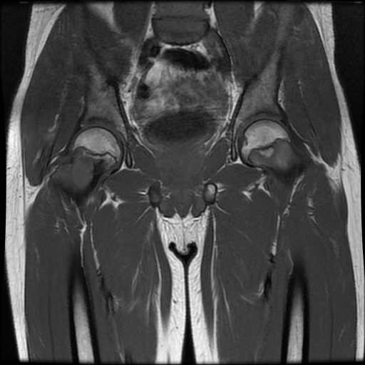 Unicameral bone cyst - femoral neck | Image | Radiopaedia.org