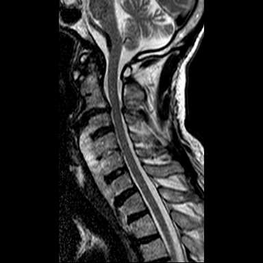 Diffuse idiopathic skeletal hyperostosis (DISH) | Image | Radiopaedia.org