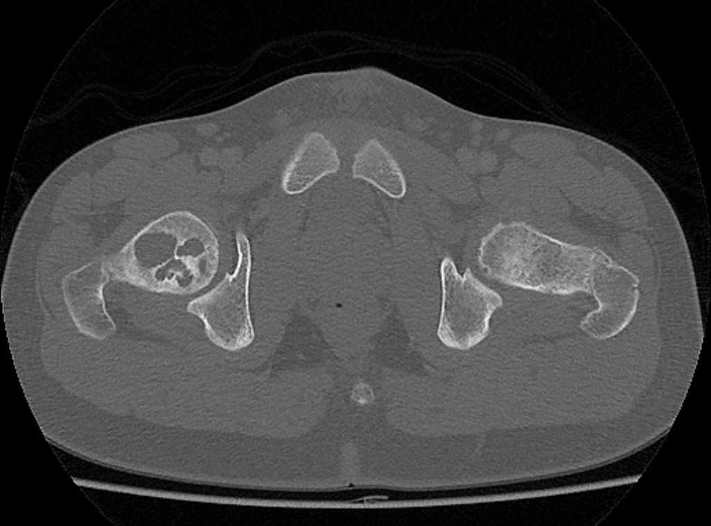 Unicameral bone cyst - femoral neck | Image | Radiopaedia.org