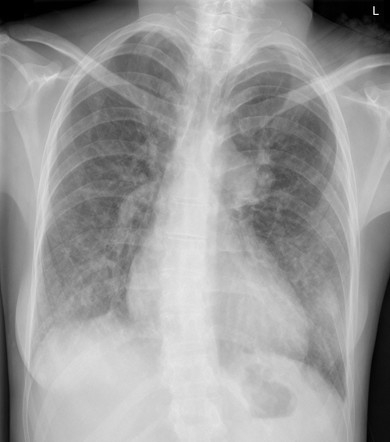 Pulmonary hypertension and oedema in Eisenmenger syndrome | Radiology ...