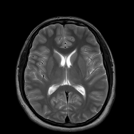 Cerebral arteriovenous malformation at posterior body of corpus ...