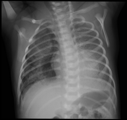 Pneumothorax in a neonate | Radiology Case | Radiopaedia.org