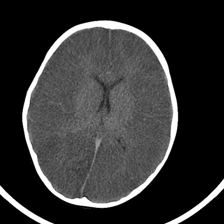 Hypoxic brain injury - white cerebellum sign | Radiology Case ...