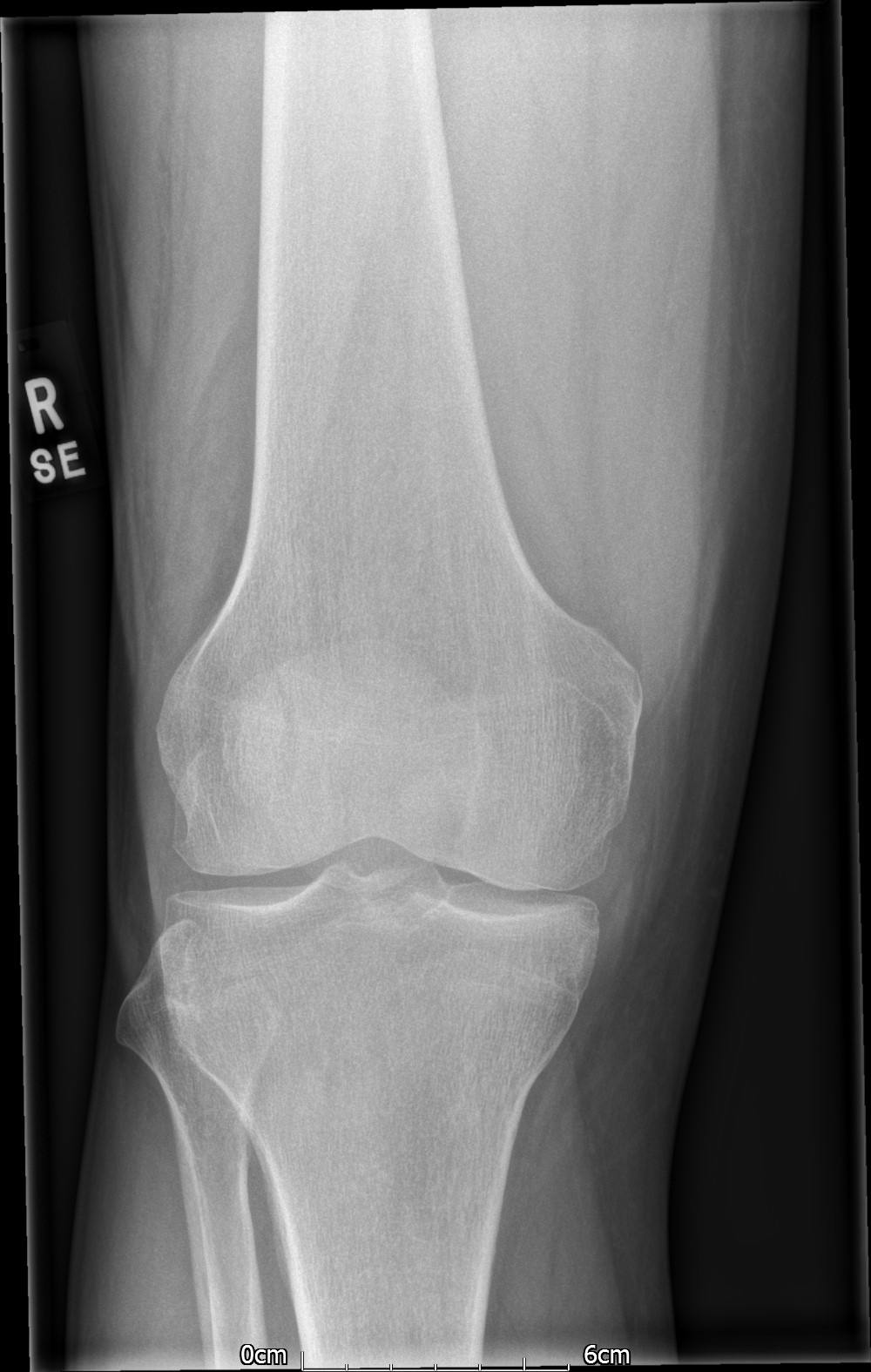 Bipartite patella | Image | Radiopaedia.org