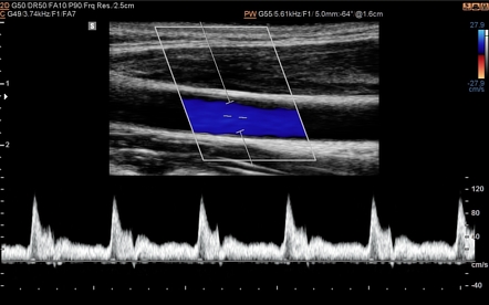 Spectral broadening (ultrasound) | Radiology Reference Article