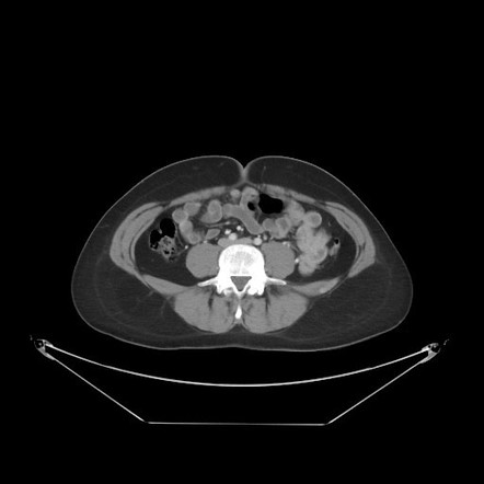 Pelvic congestion syndrome | Radiology Case | Radiopaedia.org