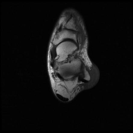 Subcutaneous bursa of lateral malleolus | Image | Radiopaedia.org