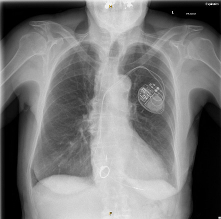 Esophageal foreign body | Radiology Case | Radiopaedia.org