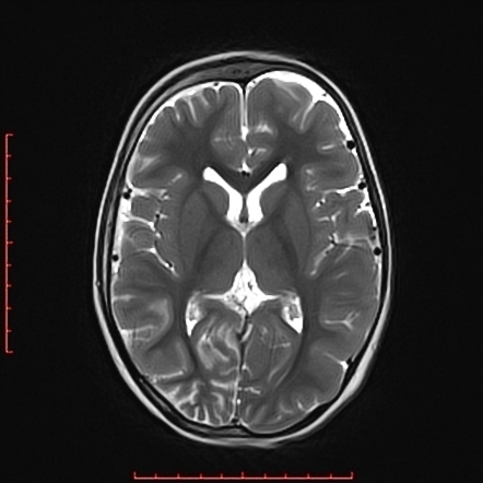 Sturge-Weber syndrome | Image | Radiopaedia.org