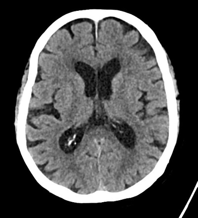 Giant Cell Arteritis 