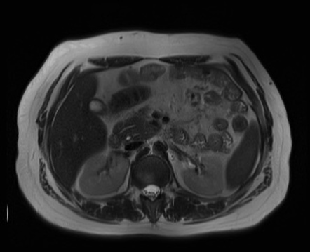 Pancreas divisum with cholelithiasis | Radiology Case | Radiopaedia.org