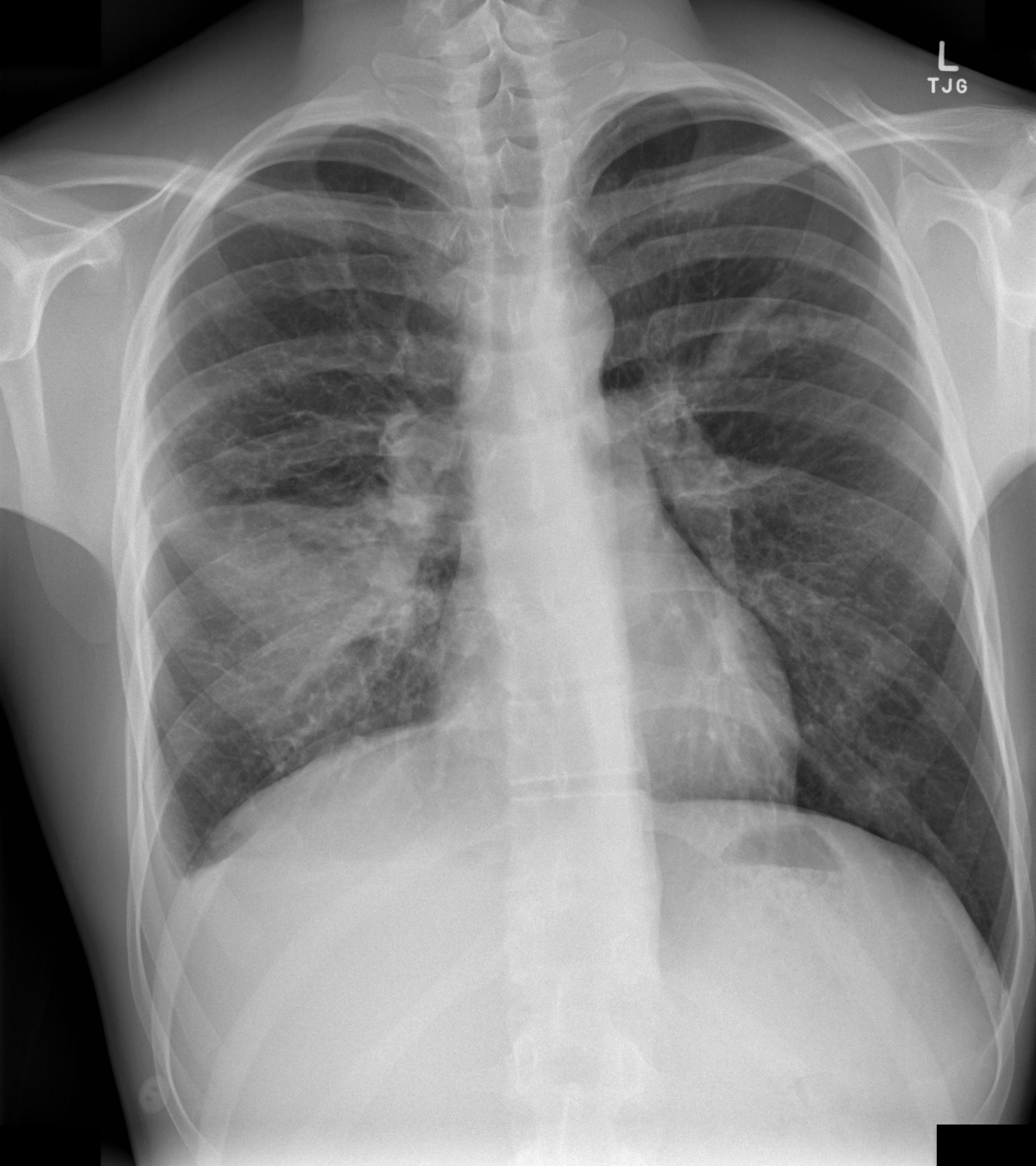 File:Middle lobe pneumonia, mucous plugging and bronchiectasis in ...