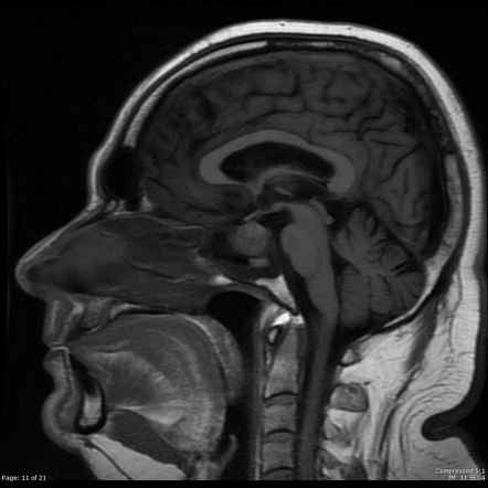 Pituitary Aspergilloma | Radiology Case | Radiopaedia.org