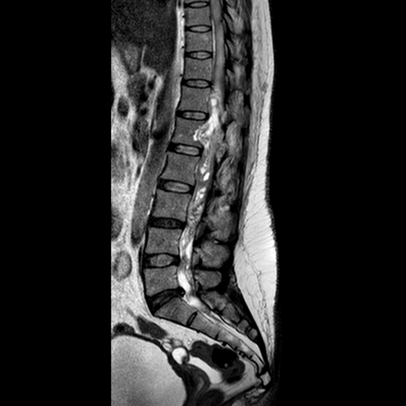 Spinal schwannoma | Image | Radiopaedia.org