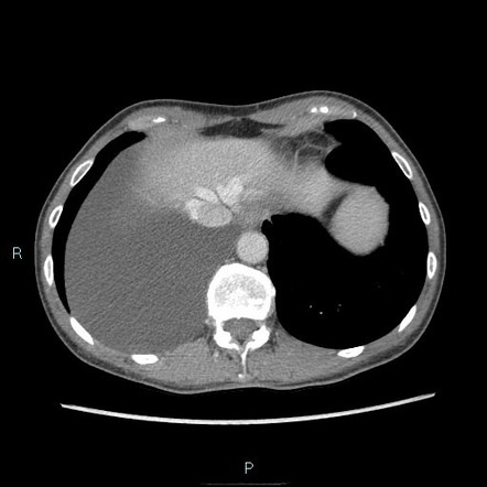 Diaphragmatic Mesothelial Cyst Radiology Reference Article Radiopaedia Org