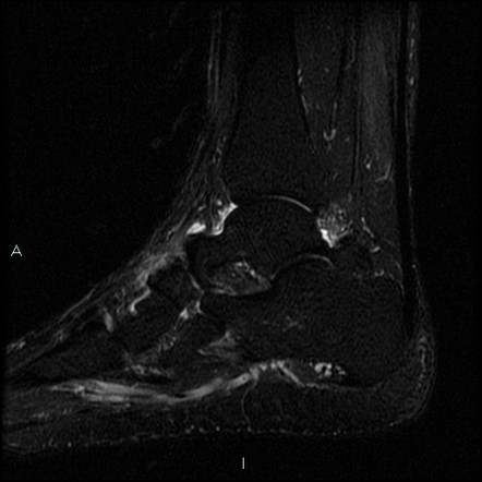 Pigmented villonodular synovitis with blooming artifact | Image ...