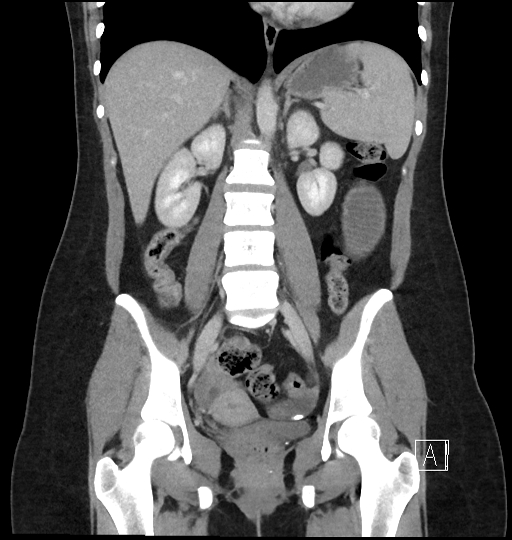 Intussusception secondary to Peutz-Jeghers syndrome | Image ...