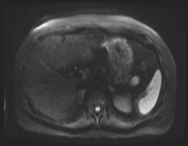 Pancreatic Neuroendocrine Tumor - Cystic | Image | Radiopaedia.org