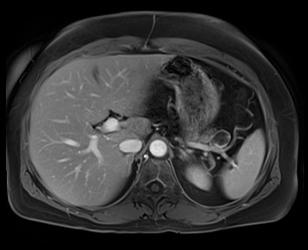 Pancreatic Neuroendocrine Tumour - Cystic | Radiology Case ...