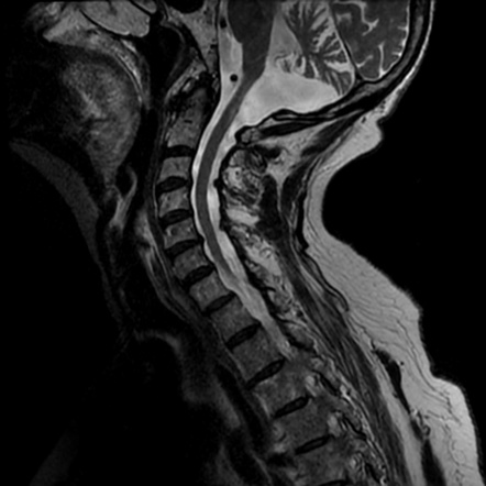 Cerebellar ataxia with neuropathy and vestibular areflexia syndrome ...