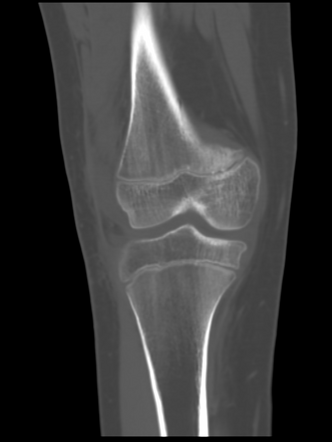 Lateral patellar dislocation with avulsion fracture | Image ...