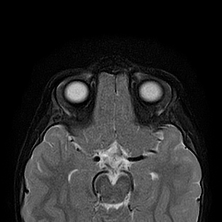 Septo-optic dysplasia | Image | Radiopaedia.org