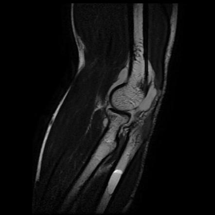 Unicameral Bone Cyst Humerus