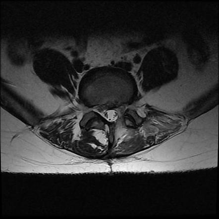 Laminectomy | Radiology Reference Article | Radiopaedia.org