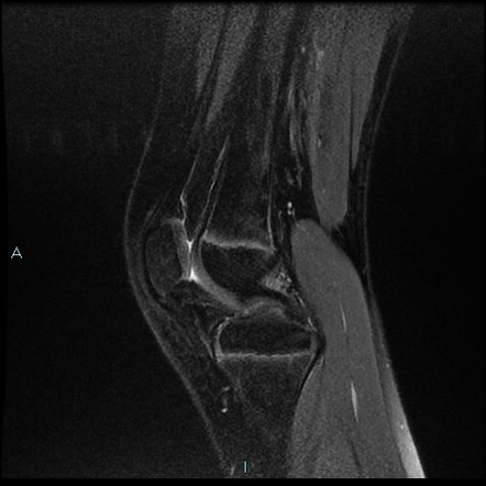 Avulsive cortical irregularity (ACI) or cortical desmoid | Image ...