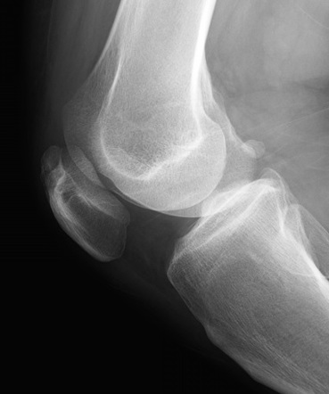 Tripartite patella | Image | Radiopaedia.org