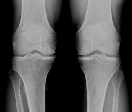 Multipartite patella | Radiology Reference Article | Radiopaedia.org