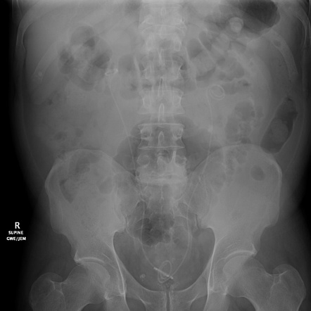 Bilateral ureteric stents | Radiology Case | Radiopaedia.org