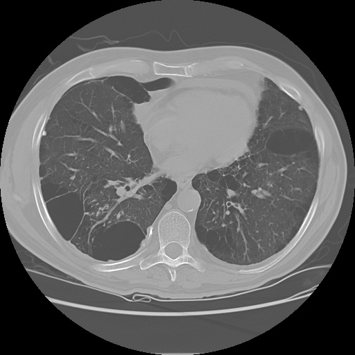 File:Mixed pneumoconiosis - silicosis, coal workers' pneumoconiosis and ...