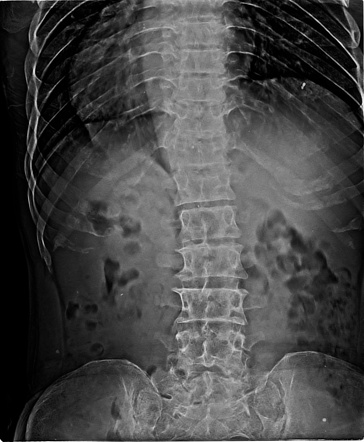 Acromegaly | Image | Radiopaedia.org