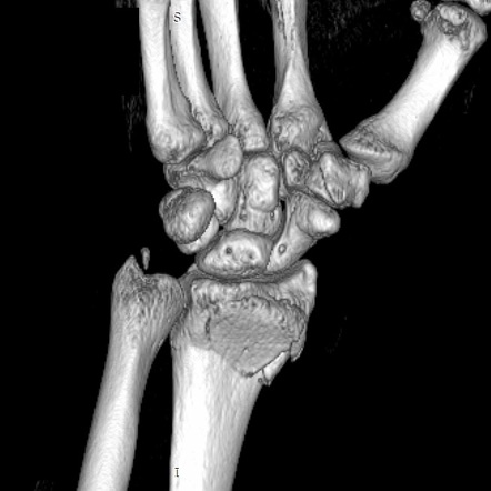 Ulnar styloid fracture | Radiology Reference Article | Radiopaedia.org