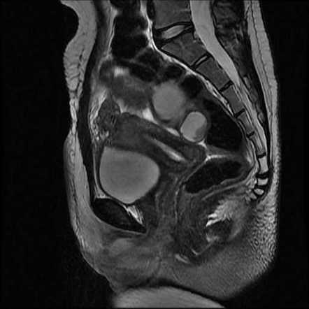 Unicornuate uterus with contralateral rudimentary horn | Radiology Case ...