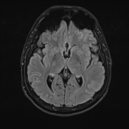 Pneumosinus dilatans frontalis | Radiology Case | Radiopaedia.org