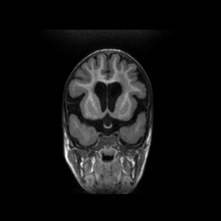 Congenital muscular dystrophies - cerebral manifestations | Image ...