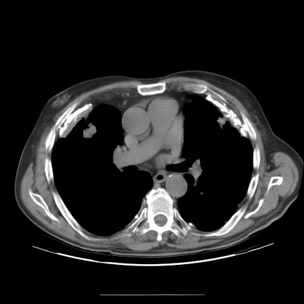 Asbestos-related pleural disease | Image | Radiopaedia.org