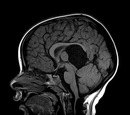 Subependymal heterotopia - cyst of the velum interpositum - syrinx ...