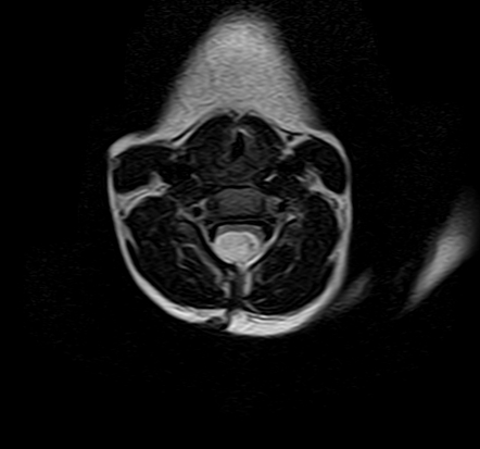 Subependymal heterotopia - cyst of the velum interpositum - syrinx ...