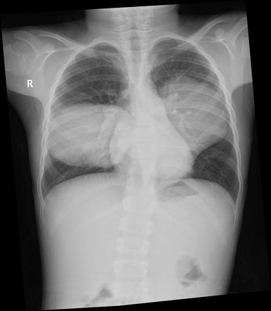 Pulmonary hydatid infection | Radiology Reference Article | Radiopaedia.org