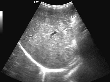 Biliary Cirrhosis Ultrasound