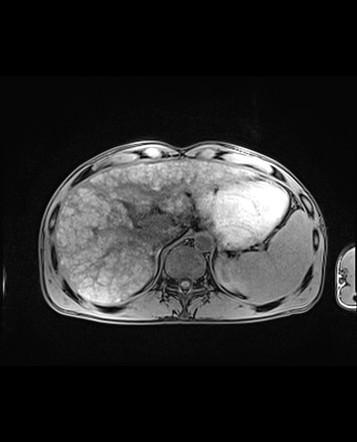 Primary Biliary Cholangitis | Image | Radiopaedia.org