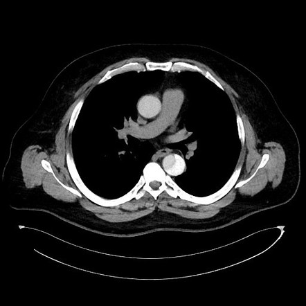 Aortic Dissection Radiology