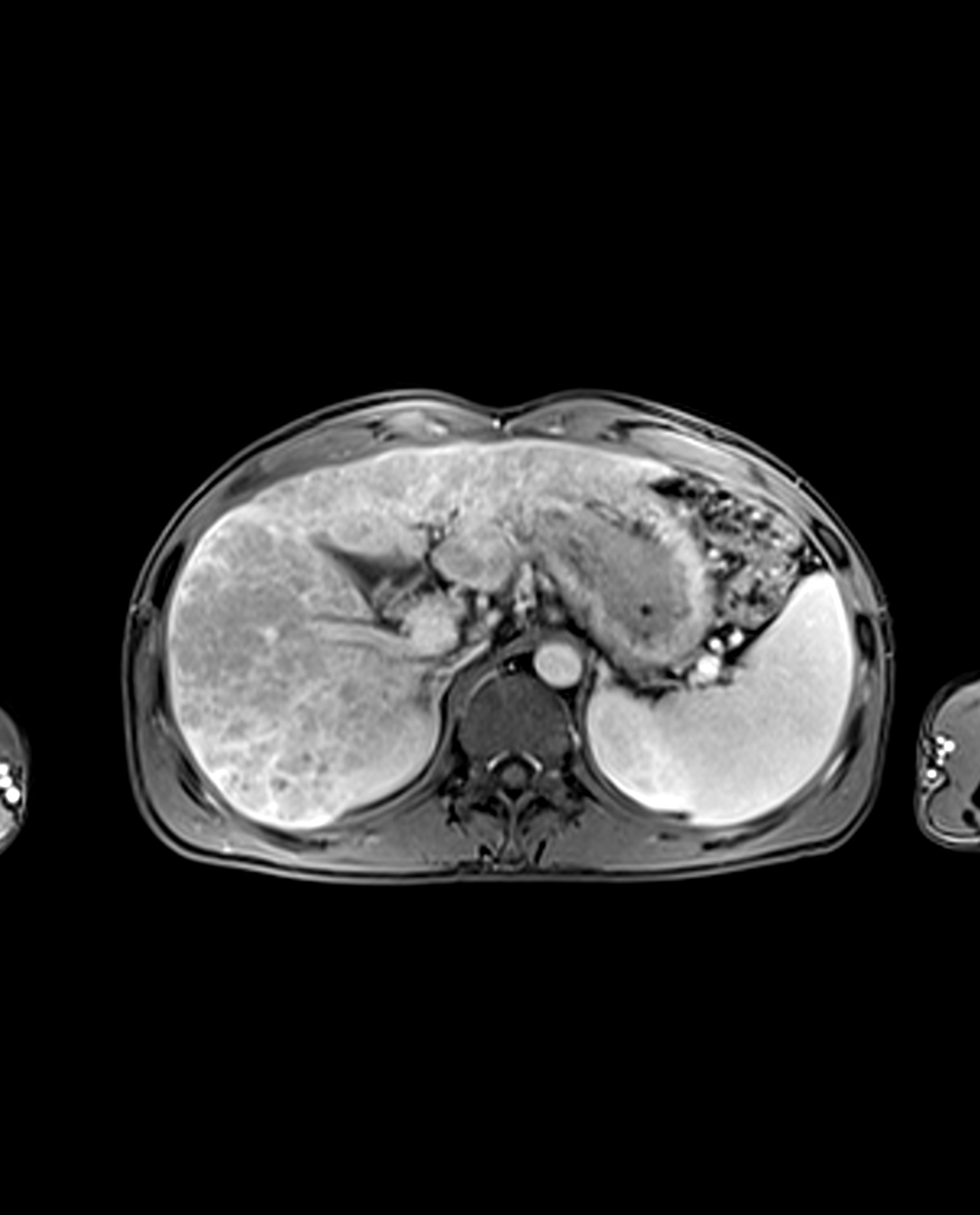 Primary Biliary Cholangitis | Image | Radiopaedia.org