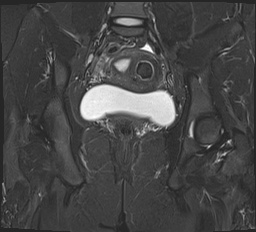 Cystic adenomyoma | Image | Radiopaedia.org